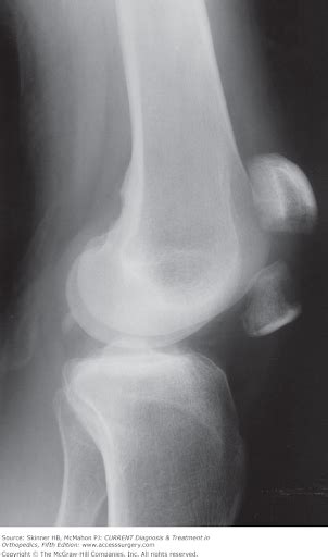 Orif Left Tibial Plateau Fracture Icd 10
