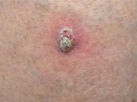 Melanoma Basal Cell Carcinoma Bcc And Squamous Cell Carcinoma Scc