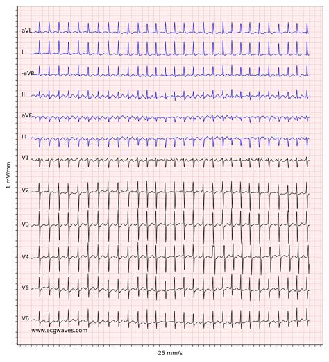 Atrial Flutter Classification Causes Ecg Diagnosis And Management