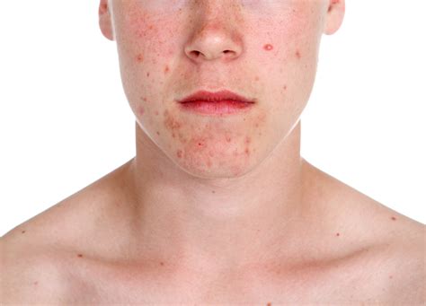 Acne Vulgaris Medical Pictures Info Health Definitions Photos