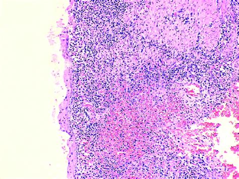 Detail On Massive Inflammation Of The Atrophic Endometrium And Adjacent