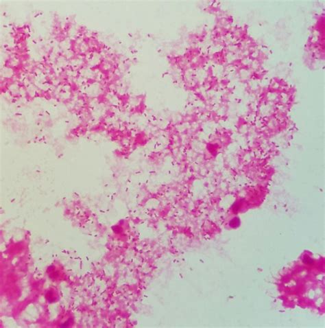 Figure 1 Gram Stain Of Blood Culture With Gram Negative Coccobacilli