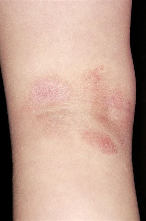 Atopic Eczema Photograph By Dr P Marazziscience Photo Library