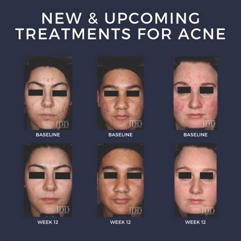 New And Upcoming Treatments For Acne Next Steps In Dermatology