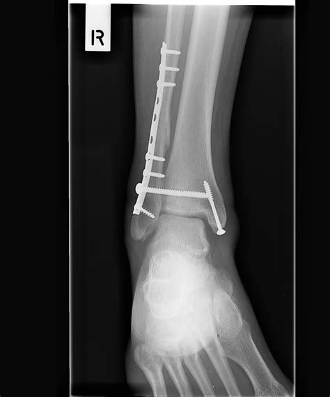 Lateral Foot X Ray Anatomy