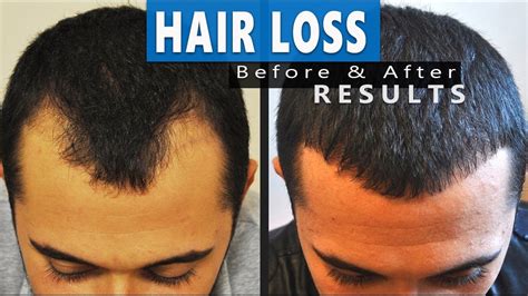 Fue Hair Transplant Before After Result Hair Loss Treatment