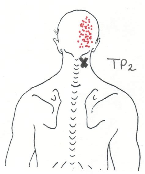 Pin On Triggerpoint Massage