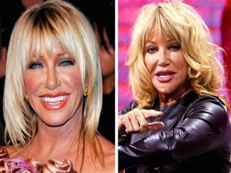 Worst Cases Of Celebrity Plastic Surgery Gone Wrong