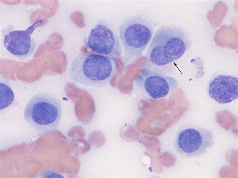 Histiocytoma Eclinpath