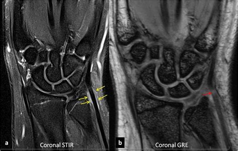 Ecu Tendinitis