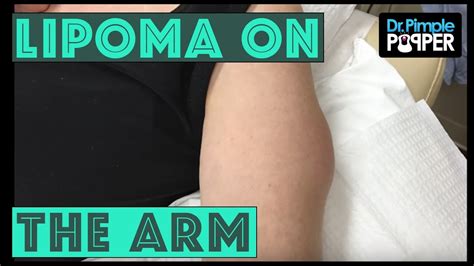 Lipoma Arm Ultrasound