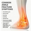 Ankle Fractures Broken Ankle | Florida Orthopaedic Institute