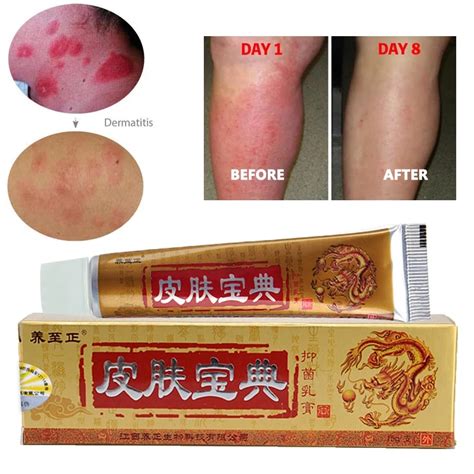 Perioral Dermatitis Treatment With Chinese Medicine Yin Yang