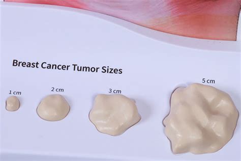 While breast oil cysts do not become cancerous and do not increase the risk of developing breast cancer, they may occur in association with underlying cancer. What Does Breast Cancer Feel Like?