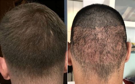 Benefits Of Fue Hair Transplant