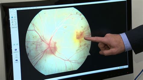 New Gene Therapy Improves Vision In Patients With Incurable Form Of