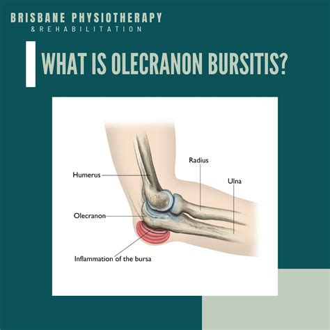 What Is Olecranon Bursitis Brisbane Physiotherapy