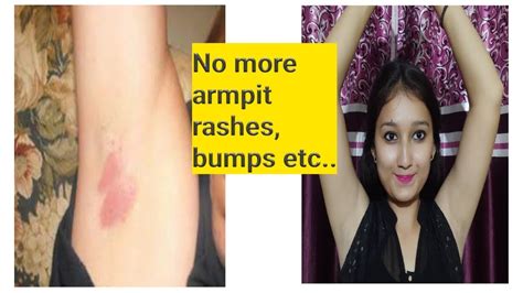 How To Get Rid Of Armpit Rashes Bumps Etc And Get Soften Armpits