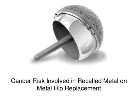 Cancer Risk Involved In Recalled Metal On Metal Hip Replacement