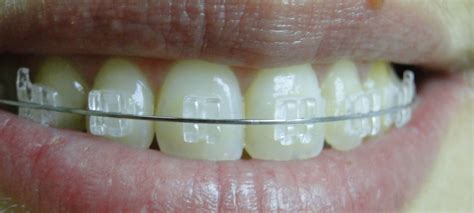 aparelho ortodontico de safira  solucao