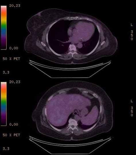 Synchronous Contralateral Axillary Lymph Node Metastasis In A Recurrent