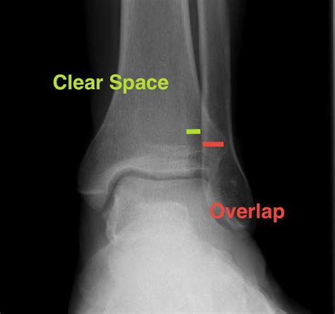 X Ray Ankle Dislocation Medworldonline