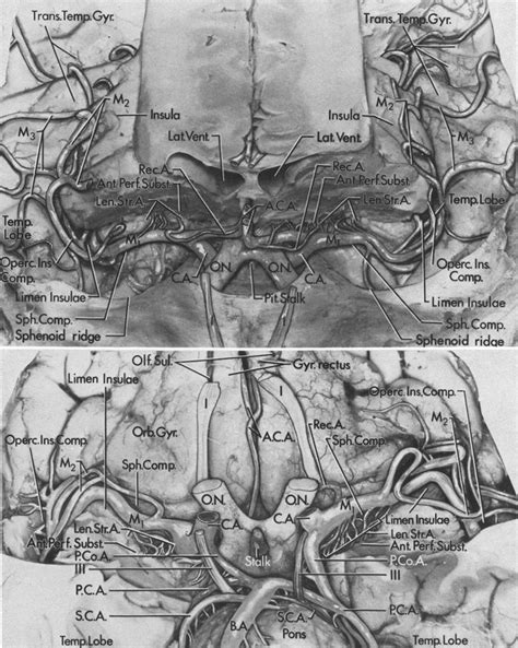 Microsurgical Anatomy Of The Middle Cerebral Artery In Journal Of