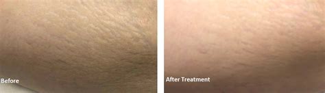 Stretch Marks Reduction Cosmetic And Laser Center