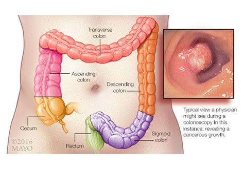 Colorectal Cancer Miss Rate Lowered Using Ai Doctors Without Waiting Rooms