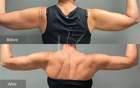 Arm Lift Before After Hz Plastic Surgery