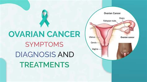 Ovarian Cancer Symptoms Diagnosis And Treatment Body Revival