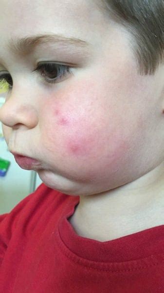 Spots On Toddlers Face Any Idea What They May Be Mumsnet