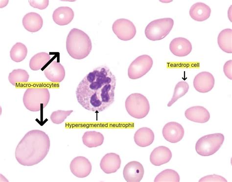 Laboratory Diagnosis Of Megaloblastic Anemia Mba