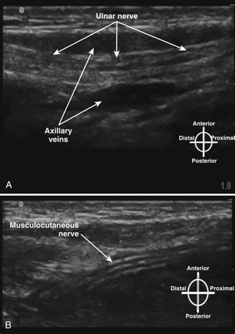 Ultrasound Of The Brachial Plexus Radiology Key