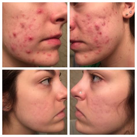 Accutane Before After