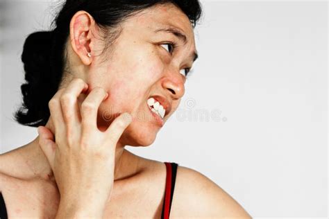 Woman Scratch Face With Skin Rash Stock Photo Image Of Face Asian