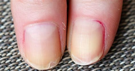 How To Stop Nails From Peeling Causes And Prevention 2023