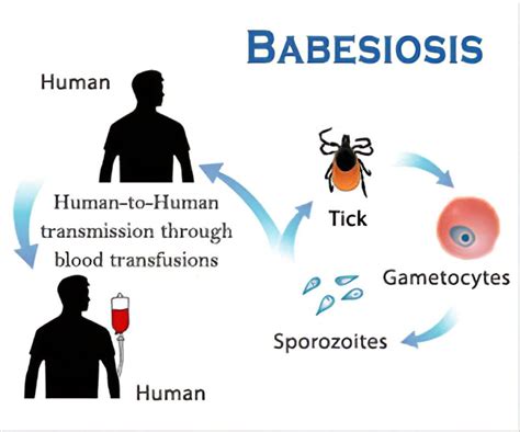 Understanding Babesiosis Symptoms Diagnosis And Treatment Ask The