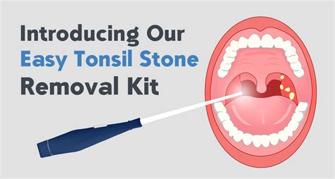 Fight Bad Breath With Our Easy Tonsil Stone Removal Kit Dr Frederick