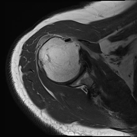 Full Thickness Supraspinatus Tear Radiology Case Radiopaedia Org