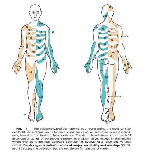 How Bad Are The Dermatomes By Tom Jesson Toms Sciatica Newsletter