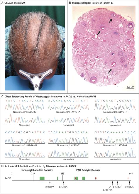 Variant Padi3 In Central Centrifugal Cicatricial Alopecia Saf