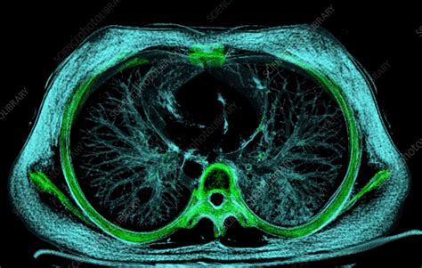 Normal Lung Ct Scan Stock Image F0365126 Science Photo Library