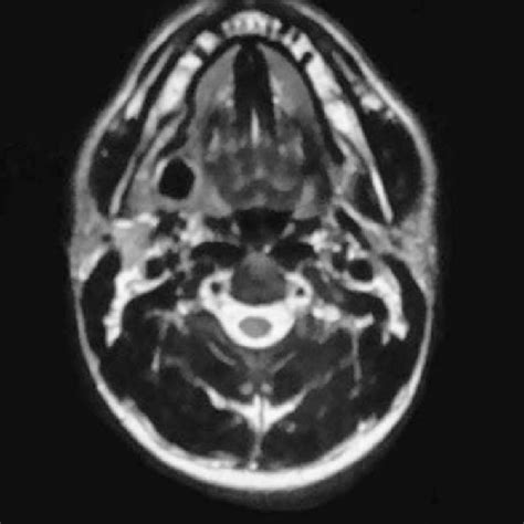 Computed Tomography Scan Of The Right Submandibular Gland Showing