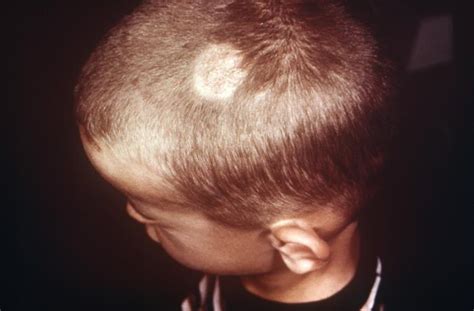 Alopecia Concise Medical Knowledge