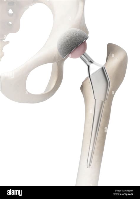 Hip Replacement Hi Res Stock Photography And Images Alamy