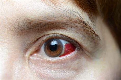 Blood Clot In Eye Due To Diabetes Diabeteswalls