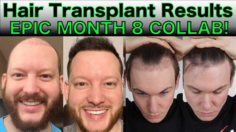 Hair Transplant Results Month 8 Gregory Gaige FUE Hair Transplant