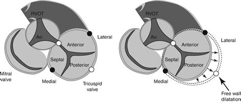 Anatomy Of The Tricuspid Valve And Pathophysiology Of Functional
