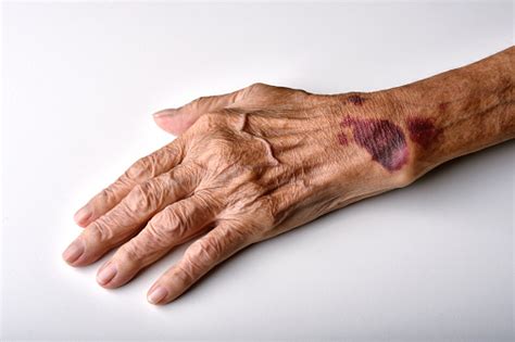 Bruise Wound On Senior People Wrist Arm Skin Falls Injury Accident In
